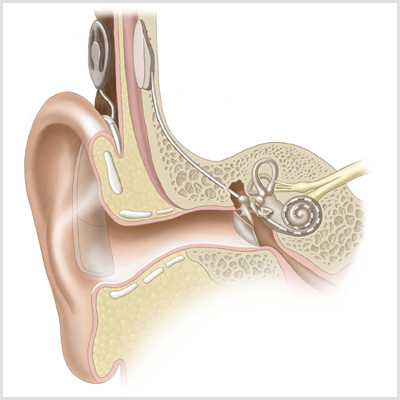 cochlear implant thumbnail