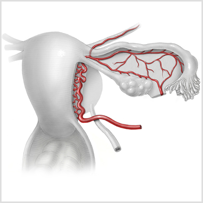 uterine artery thumbnail